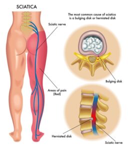 Đau Thắc Lưng Thần Kinh Tọa