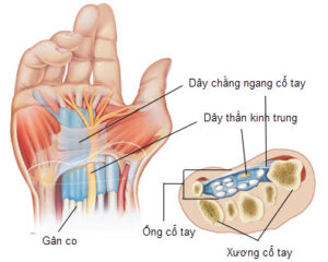 Hội chứng ống cổ tay